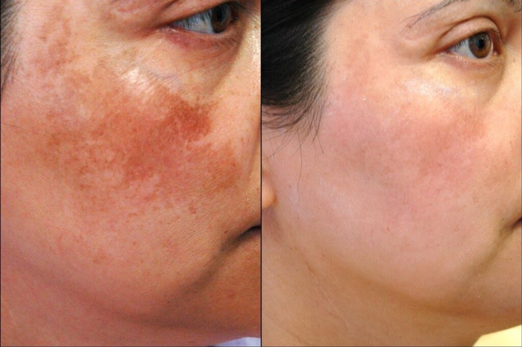 Melasma treatment in Aurangabad at Dr. Dahiwals Facial Aesthetics & Dental Clinic
